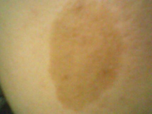 上海哪家医院看咖啡斑最好