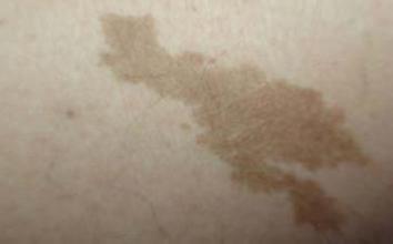 上海哪家去咖啡斑医院好