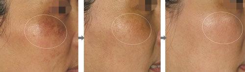 上海哪家去咖啡斑好