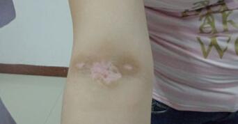 白癜风的典型症状