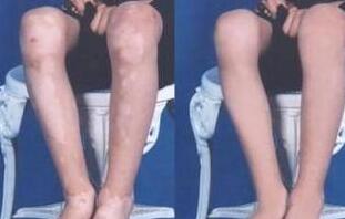 四肢白癜风怎么护理