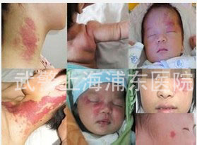 图:我国胎记发病率逐年增加,引起卫生部高度重视和关注