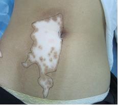 白癜风的临床表现