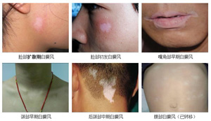 医生介绍白癜风的诊断