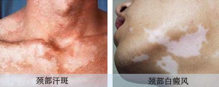 导致颈部白斑的原因有什么