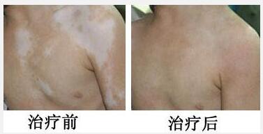 早期胸部白癜风什么样