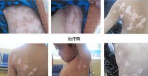 女性腰部患白癜风怎么办