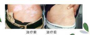 女性腰部白癜风病发初期症状