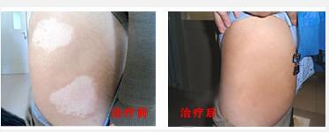 初期儿童腰部白癜风什么样