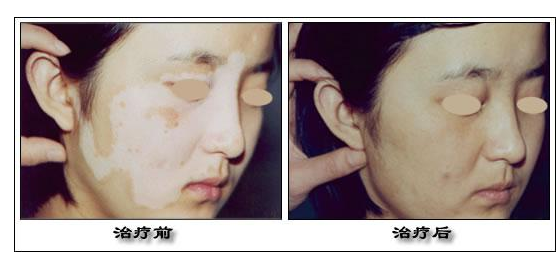 毛囊型白癜风有什么影响