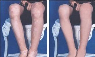 肢端型白癜风患者能晒太阳吗