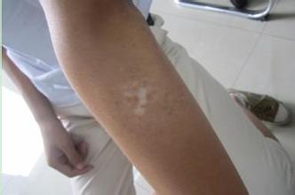 早期的节段型白癜风