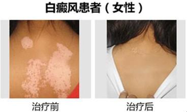 泛发型白癜风怎样护理