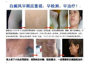 初期白癜风症状是什么样的