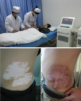 治疗白癜风哪些药物需要注意