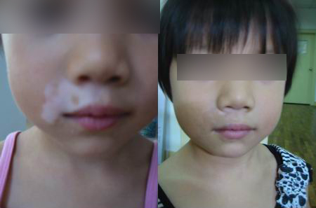 儿童患白癜风的注意事项