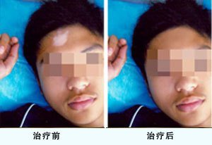 男性白癜风会有哪些危害