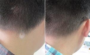 男性白癜风是什么因素引起的