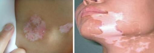 如何治疗颈部白癜风较有效