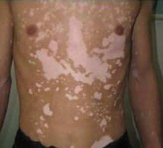 胸部白癜风为什么会扩散