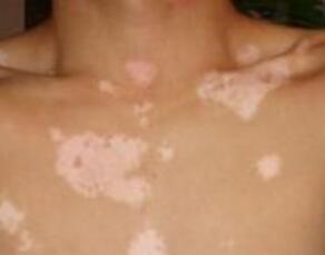 诱发胸部白癜风的原因有什么