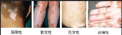 节段型白癜风患者的护理方法