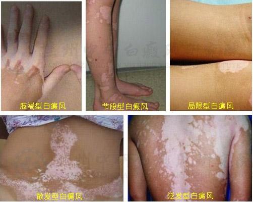 患节段型白癜风有什么危害