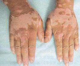 泛发型白癜风常见的症状