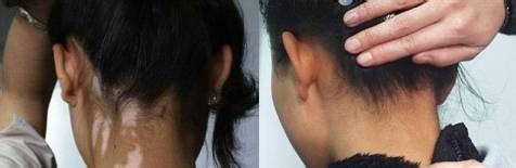 青少年泛发型白癜风的护理