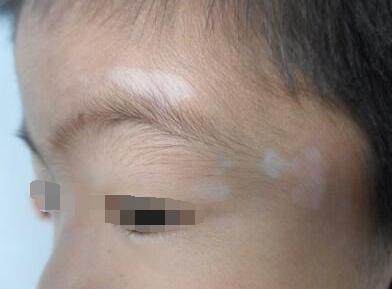 孩子脸部患白癜风的原因