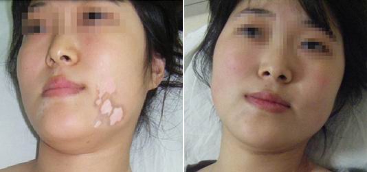 女性白癜风治疗时注意些什么