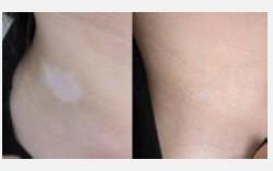 颈部白癜风恶化是什么原因