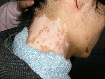 颈部白癜风有哪些注意事项