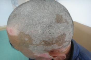 如何正确治疗白癜风