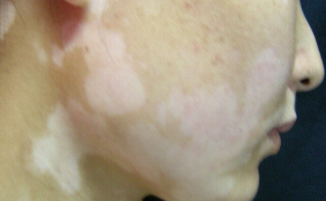 白癜风是怎么引起的