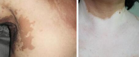 白癜风发病前期