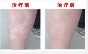 腿上白癜风有什么症状