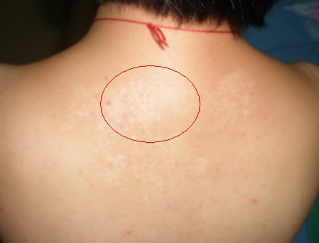 背上白癜风有什么症状