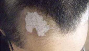 头部白癜风症状