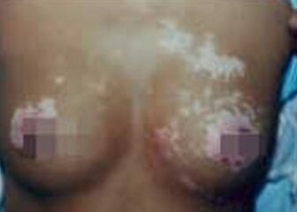 女性胸部白癜风是怎么引起的