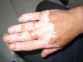 手部白癜风症状