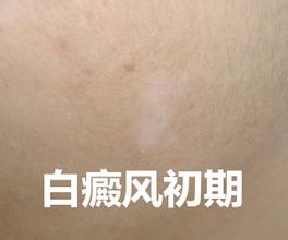 白癜风有哪些症状