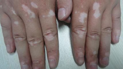 右手白癜风有哪些症状