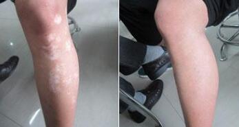 大腿白癜风怎么检查诊断