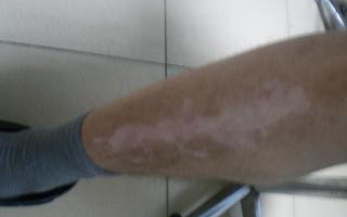右腿白癜风有哪些主要症状