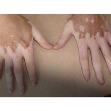 双手白癜风治疗要注意什么