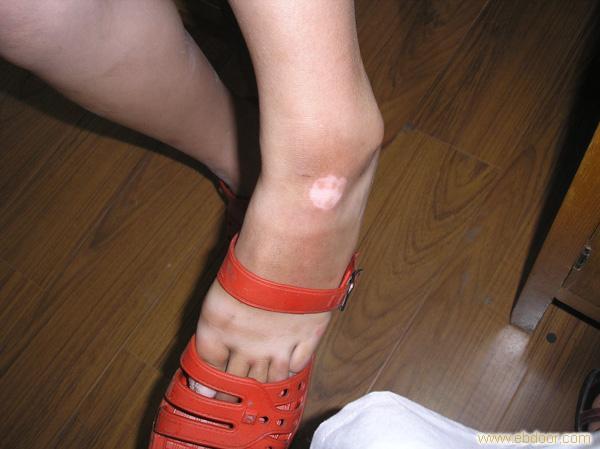 脚上白癜风怎么护理