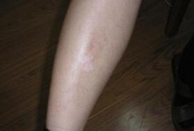 左腿白癜风有哪些注意事项