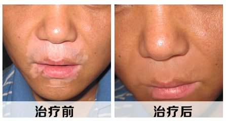 为什么儿童会患白癜风