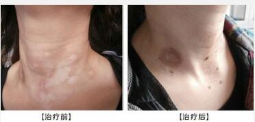 颈部出现白癜风是什么原因